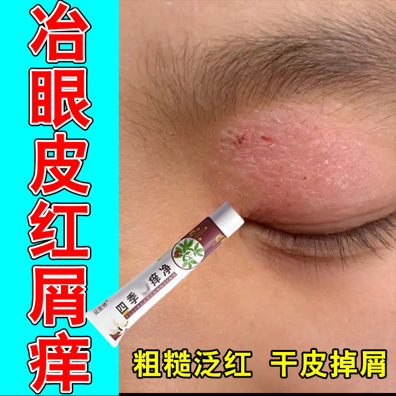 眼皮红肿痒眼睛周围过敏发痒神经性眼角干燥起皮掉屑保湿软膏