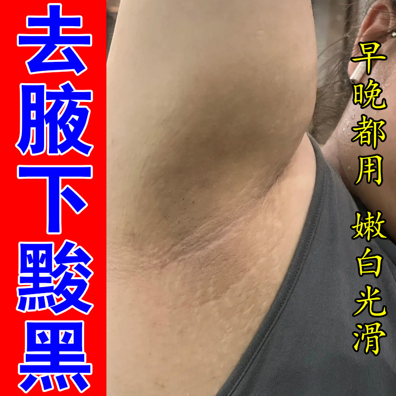 腋窝肤色发暗腋下褶皱粗糙胳肢窝色素沉淀腋下发黑肌肤暗沉按摩膏