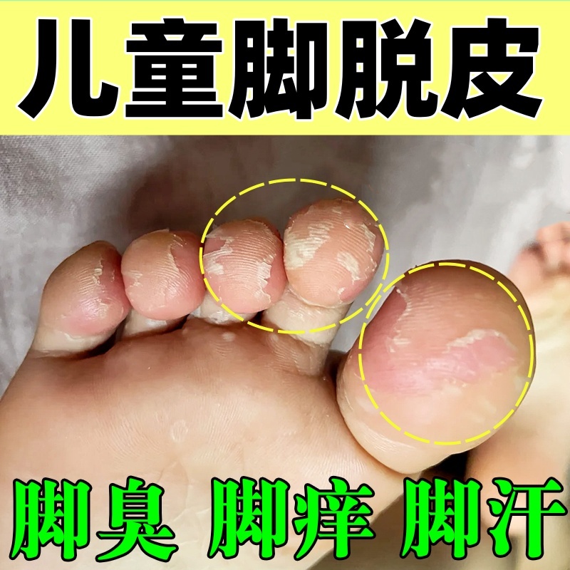 儿童脚脱皮脚趾头蜕皮专用膏脚痒烂脚丫起水泡脱皮脚臭杀菌止痒膏