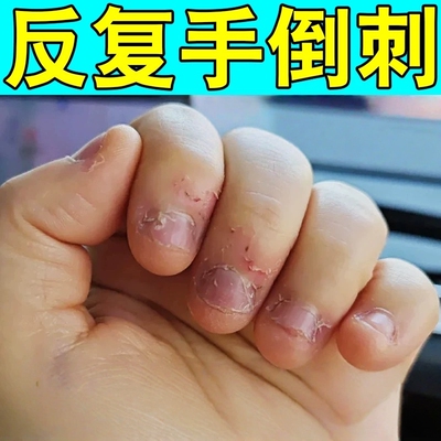 手指倒刺营养油修复损伤儿童成人去倒刺神器指甲边干裂脱皮起皮膏