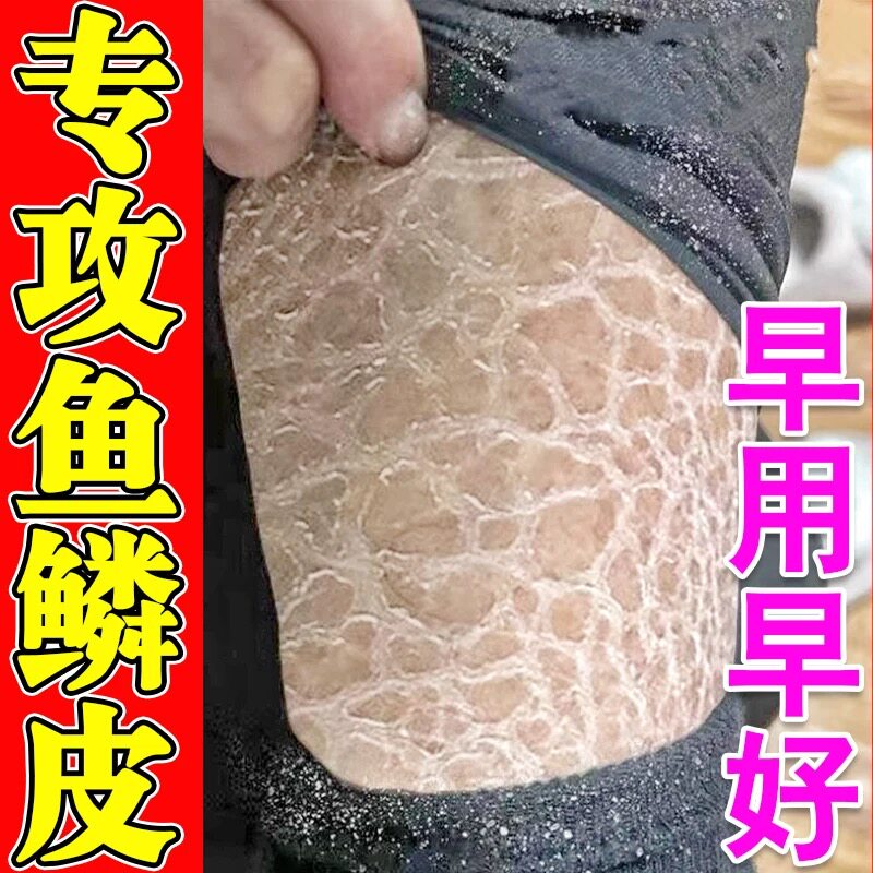 鱼鳞病皮肤霜秋冬天腿上干燥起皮痒掉屑去蛇皮鸡皮保湿补水身体乳
