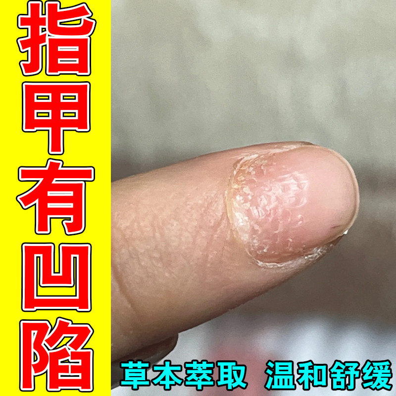 冶指甲残缺受损指甲凹陷变形坑洼手指甲凹凸不平萎缩草本修护液