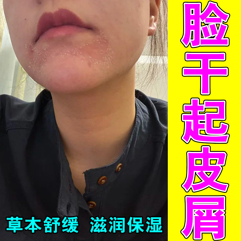 脸上干燥发干嘴角起疙瘩干燥起皮掉皮屑痒脸部皮肤过敏发痒甘油