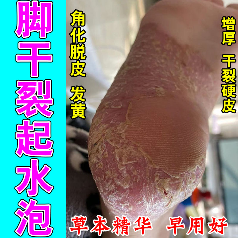 冶掌趾干裂手掌脚掌手脚干燥起皮角质增厚泛红干裂粗糙保湿用软膏