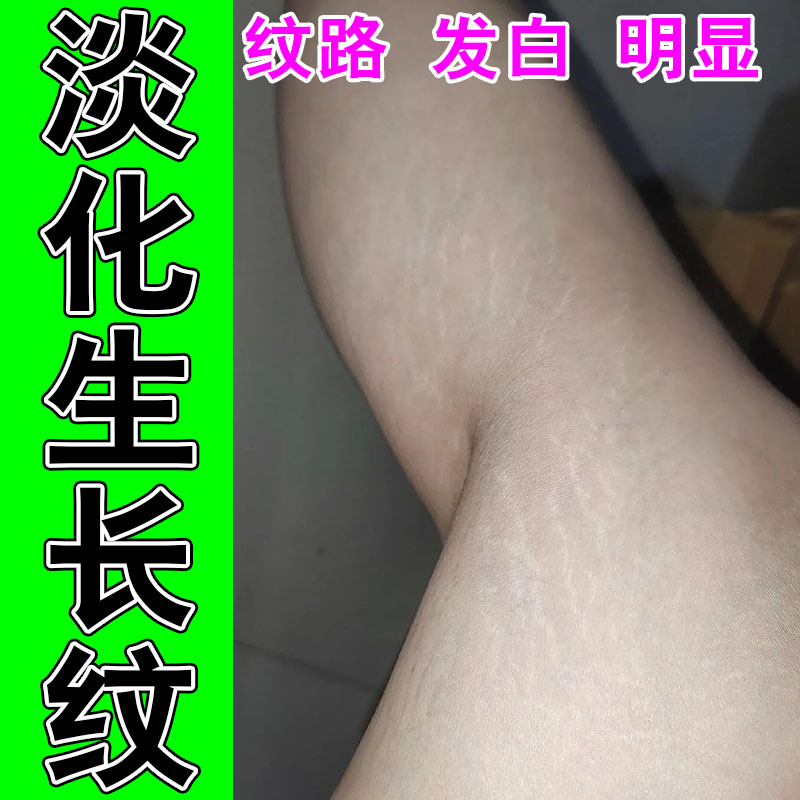 淡化肥胖纹生长纹学生大腿内侧屁股白色肥胖纹路淡化修复膏
