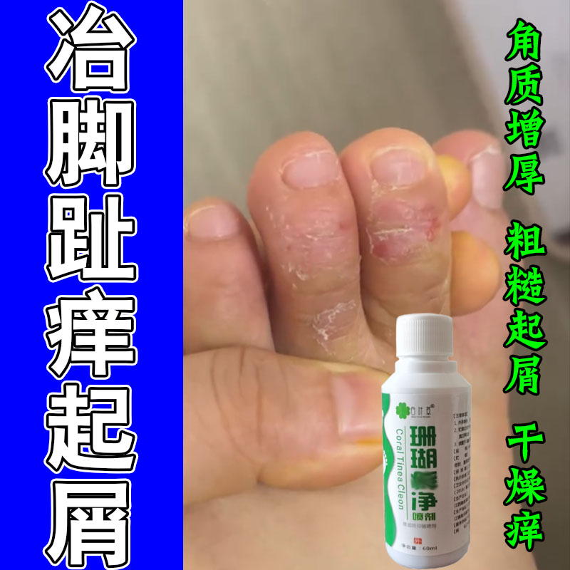 脚趾关节角质层厚粗糙修护软膏脚趾头红斑疙瘩粗糙保湿草本修护膏