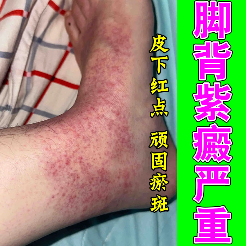 紫癜皮肤淤点红点呵护肌肤色素沉淀儿童老年外用软膏