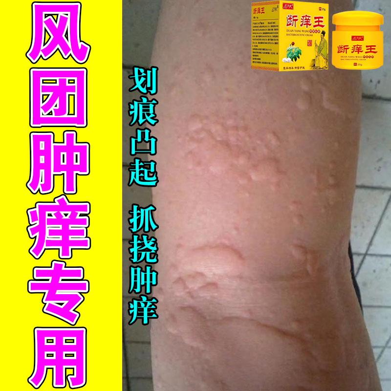 风团疙瘩四肢躯干抓完凸起泛红划痕免疫力低红肿发痒干痒修护膏