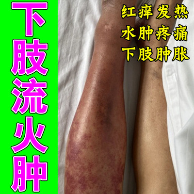 小腿流火肌肤刺痛灼热泛红腿脚红肿发烫天然草本修护乳膏