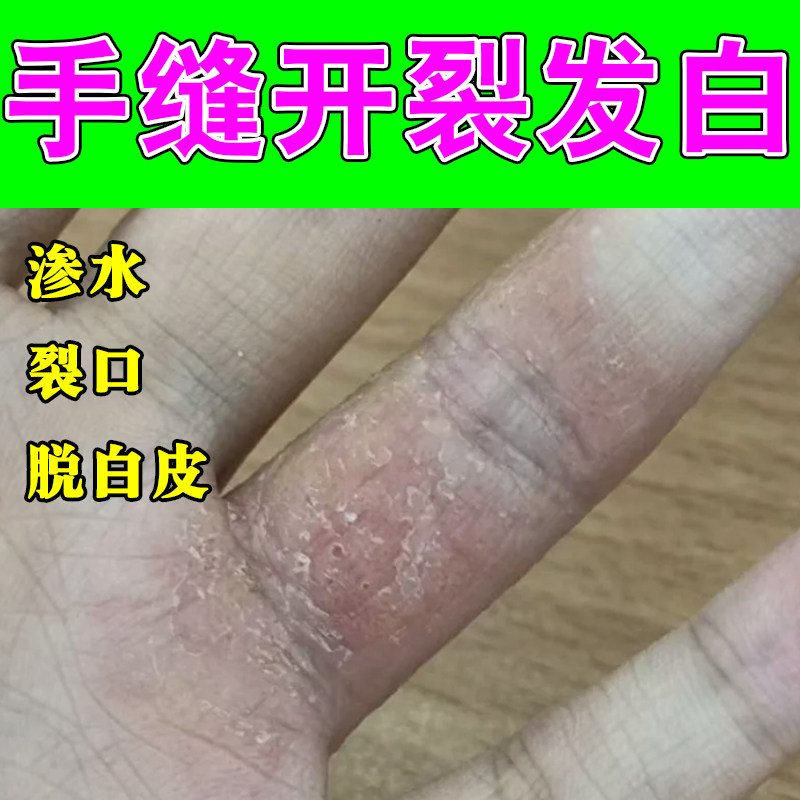 手指缝脱皮脱皮红痒长期泡水起皮手丫发白起皮长小水泡痒专用软膏