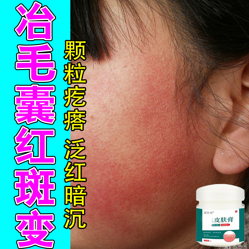 毛囊红斑黑变面颊毛周角质颗粒凸起暗沉脸部泛红黑变粗糙修护膏