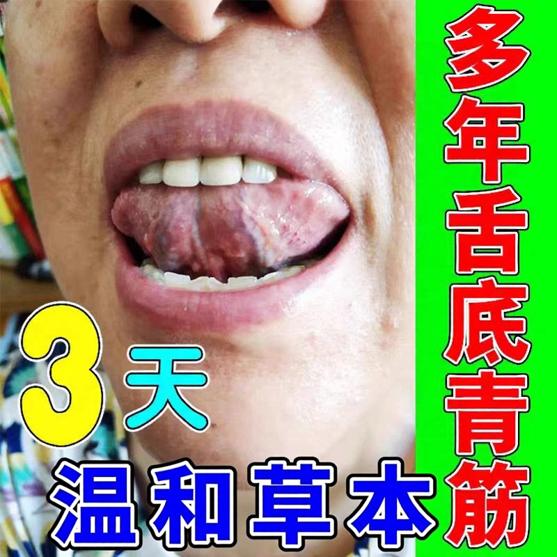 舌下青筋舌下静脉血管变黑淤血肿痛麻木舌下溶栓口腔专用喷剂