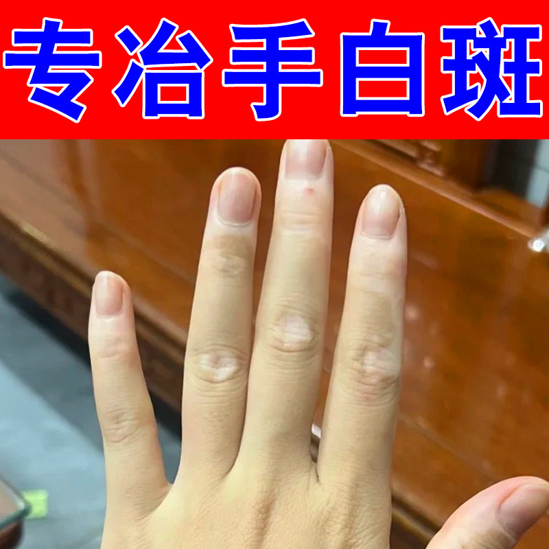 手背长白斑外用修复手上身上皮肤促进黑色素生长补骨智修护膏