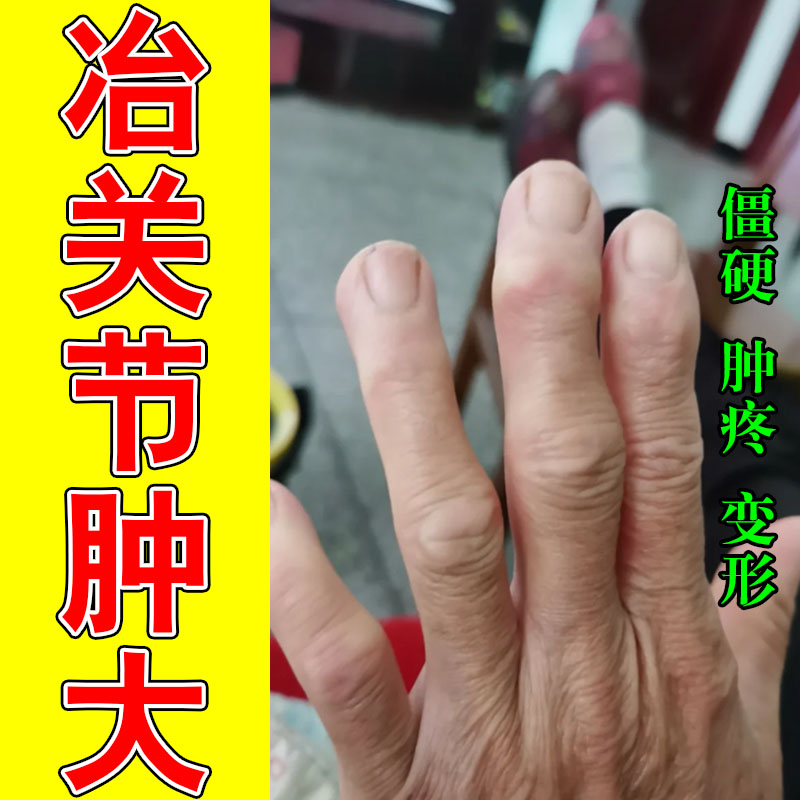 手关节疼痛专用修复手灵活手指粗大鼓包肿胀僵硬修护草本膏乳