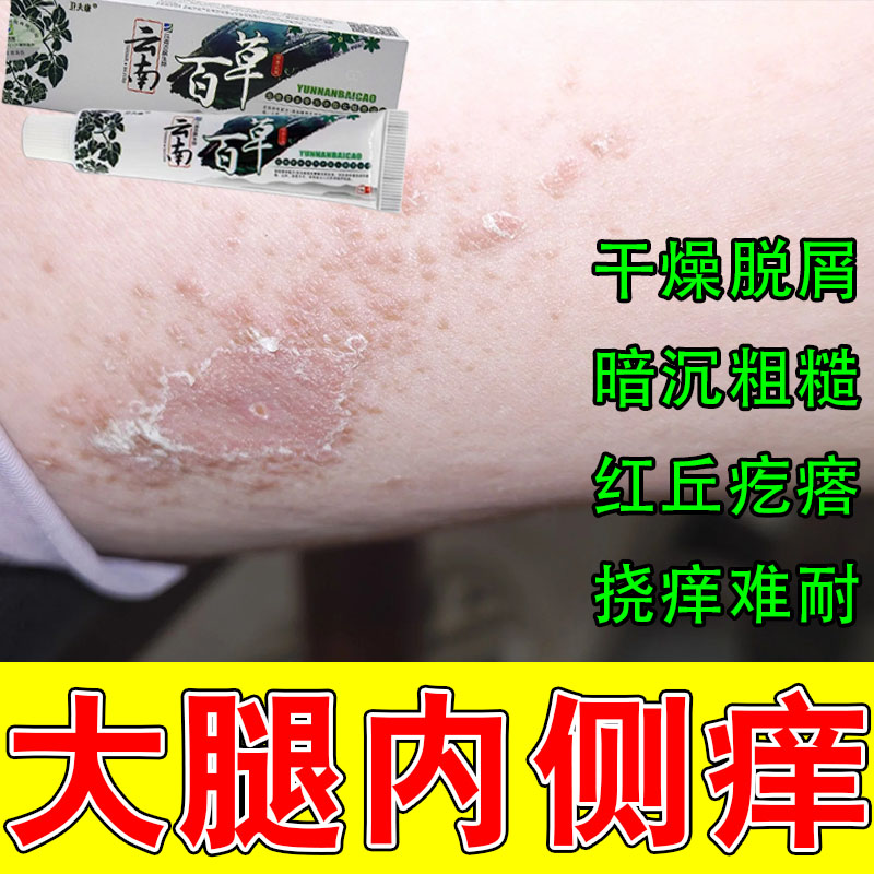 屁股痒大腿内侧私处皮肤发痒两侧红斑干燥脱皮痒粗糙发痒修护膏
