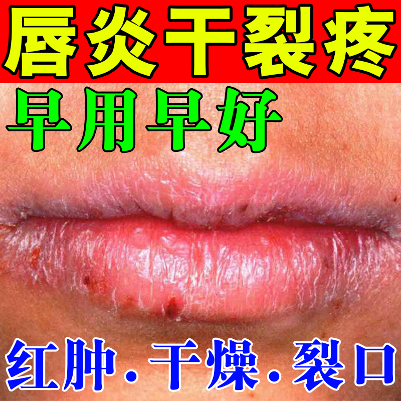 唇炎专用唇膏防嘴唇干裂脱皮嘴唇起干皮干裂嘴角口周皮炎红肿瘙痒