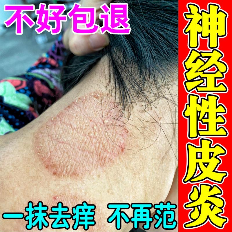 治疗神经性皮炎去祛根除外用膏日光性过敏湿诊皮肤瘙痒止痒专用膏