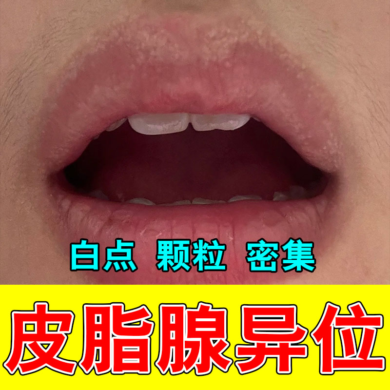 嘴唇上长小白点皮脂腺异位增生嘴唇白点起皮脂肪粒起泡草本修护膏
