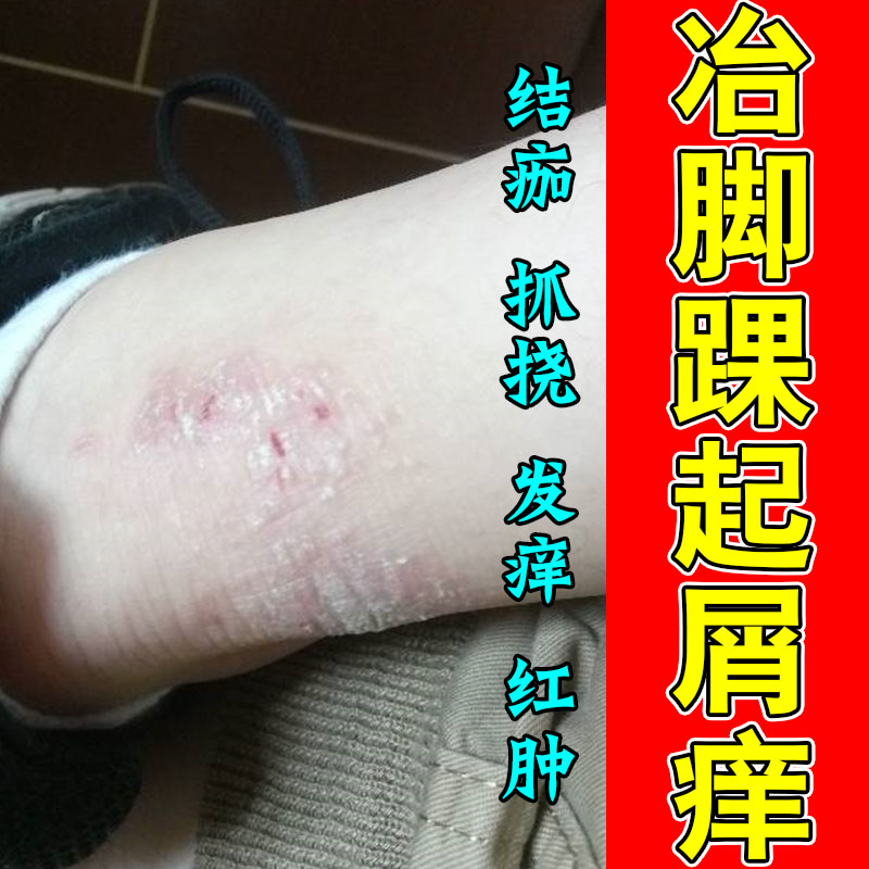 脚踝长红屑斑点皮肤痒脚脖子腿部皮肤干燥发痒起皮掉皮外用膏