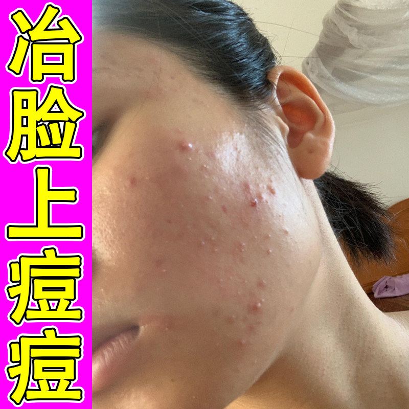 冶脸上长痘痘修复药霜脸颊逆光小疙瘩痘脸颊起闭口粉刺痘专用软膏