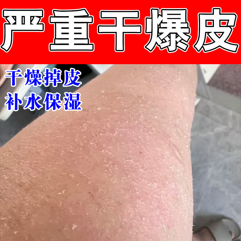 腿上干燥起皮小腿皮肤痒干燥粗糙起皮掉皮腿部护肤甘油保湿油