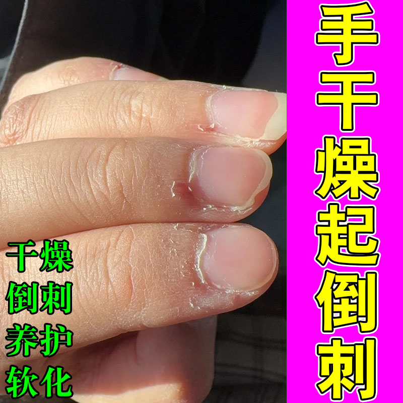 手指倒刺草本膏乳儿童有肉刺指甲边缘干裂起皮防倒刺修复保湿膏