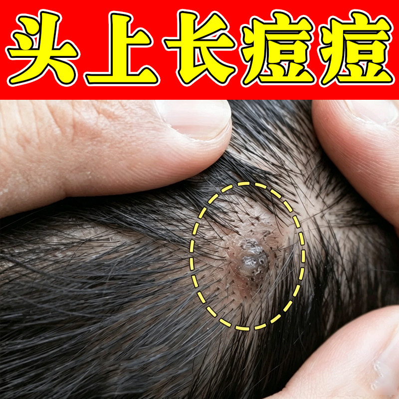 头皮毛囊头上长痘痘硬块疙瘩药头部红肿起脓包毛囊堵塞痒修复乳膏