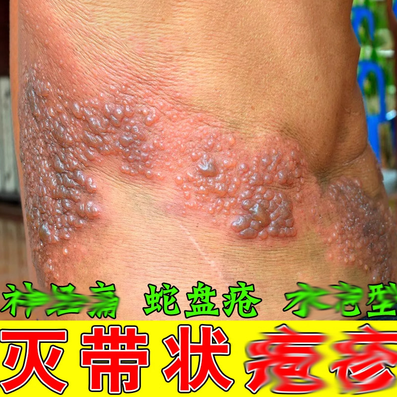 蛇缠腰药蛇盘蛇腰龙腰腹疼痛红乳膏