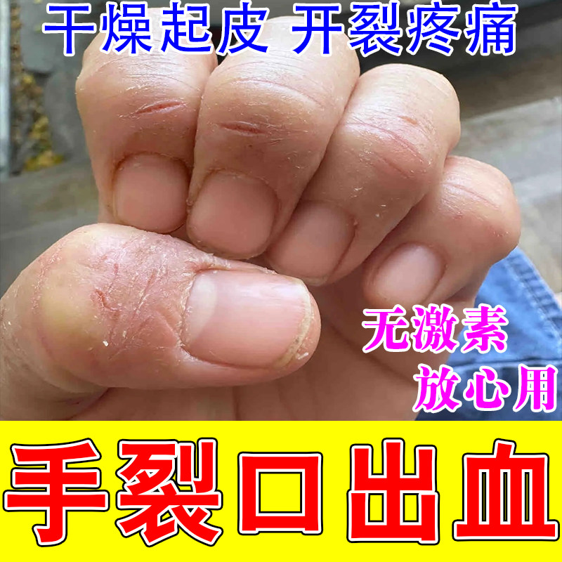 手干裂手指裂口干裂粗糙手指头开裂口流血疼痛脱皮修复保湿膏
