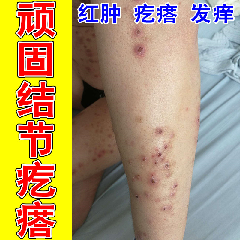 结节性疙瘩顽固皮肤硬块红斑疙瘩痒成片结痂红修护草本膏