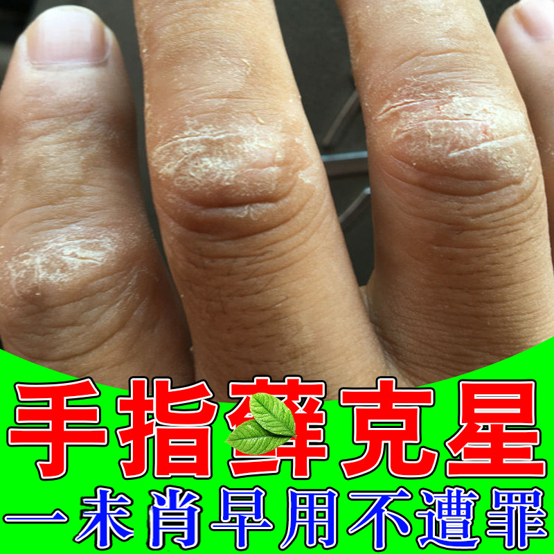 关节性顽固神经性皮痒手指关节痒真菌感染手背关节粗糙干痒膏药