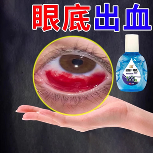 眼底血眼药水眼球上有红血丝视物模糊看不清楚眼里有异物感黄斑
