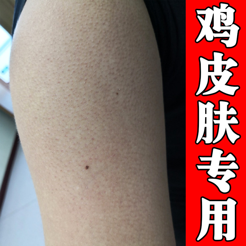 鸡皮专用膏手臂毛囊堵塞长小颗粒疙瘩腿上干燥粗糙起小黑点疙瘩药