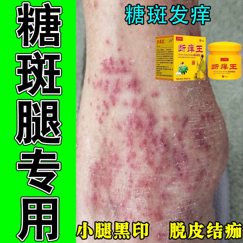 小腿脚部糖斑肌肤干痒大块褐色斑起皮疙瘩干燥颜色暗沉植物修护膏