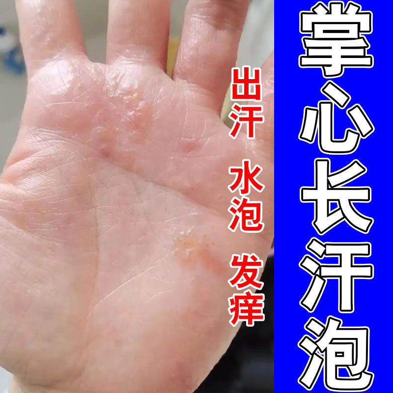 手指起透明疙瘩水泡出汗痒长水泡颗粒发痒草本修护保湿膏