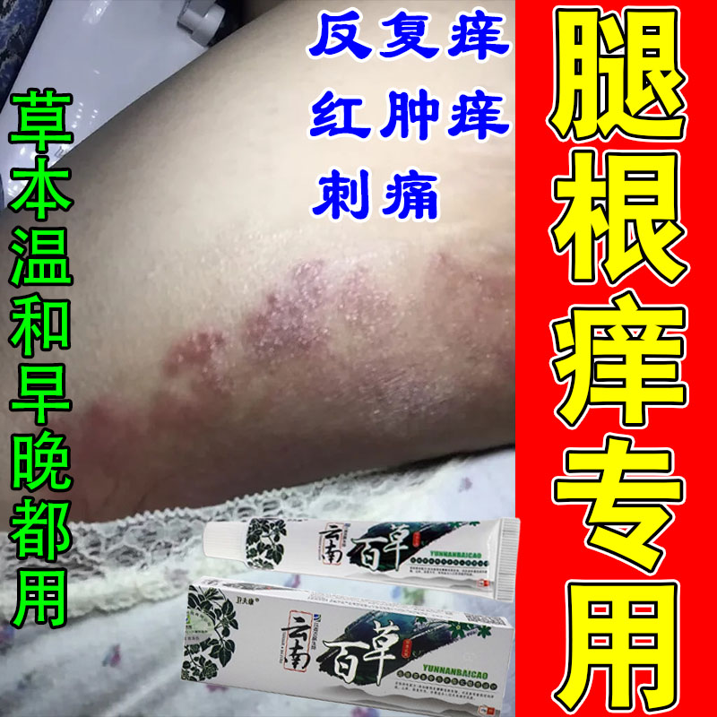 冶大腿内侧干痒疙瘩痒起红斑长红点粗糙挠痒干燥红疙瘩专用膏乳