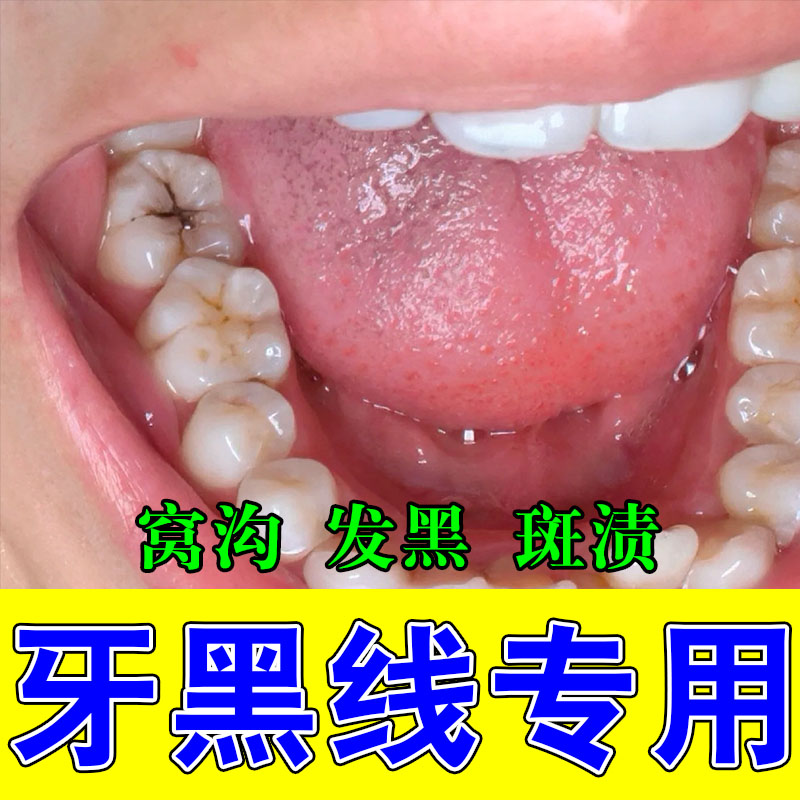 牙膏黑线黑渍牙窝沟专用清洁牙齿蛀牙菌斑牙缝发黑清洁液