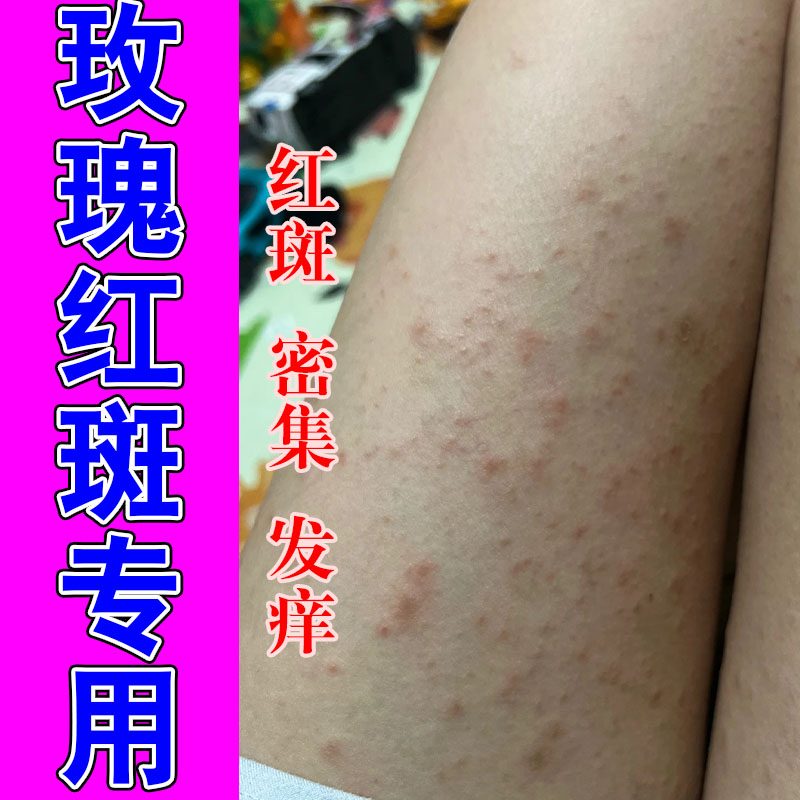 玫瑰红斑胳膊起红疙瘩红斑痒皮肤过敏痒粗糙起屑草本修护保湿乳膏