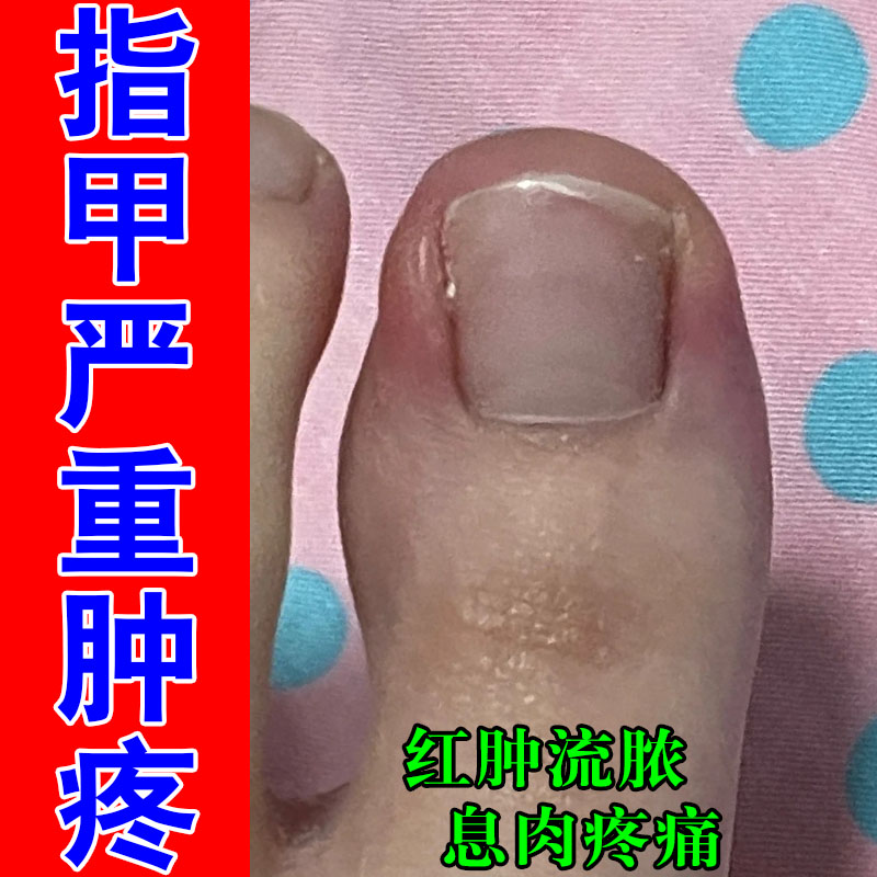 甲沟嵌甲红肿软甲膏指甲息肉肿大脱皮草本修护舒缓疼痛专用乳膏