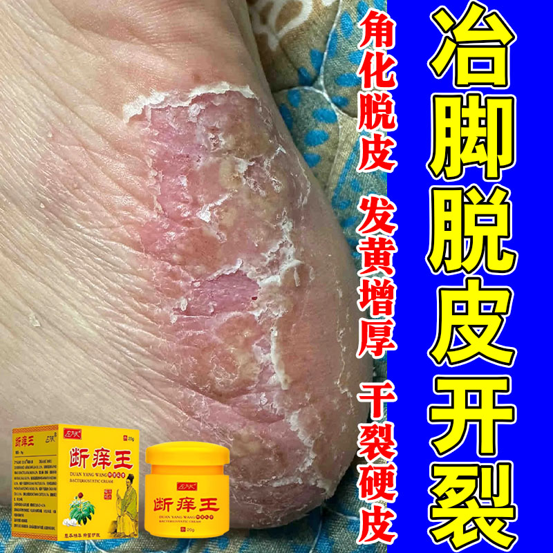 手脚掌跖角质手脚干燥起皮脱皮干裂泛红粗糙肌肤舒缓养护外用膏