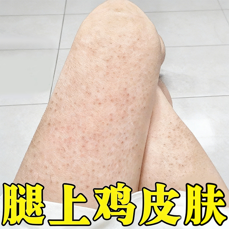 腿上鸡皮疙瘩粗糙小颗粒黑点疙瘩手臂胳膊长小丘颗粒