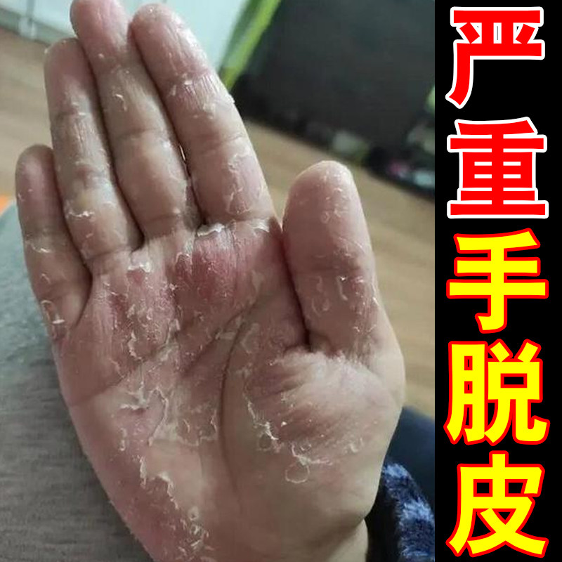 手指头起皮干裂真菌专用膏手掌严重感染蜕皮儿童手心掉皮干燥粗糙
