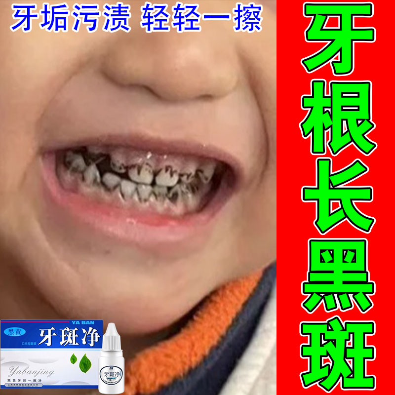 牙膏黑线黑渍牙窝沟专用清洁牙齿蛀牙菌斑牙缝发黑清洁液