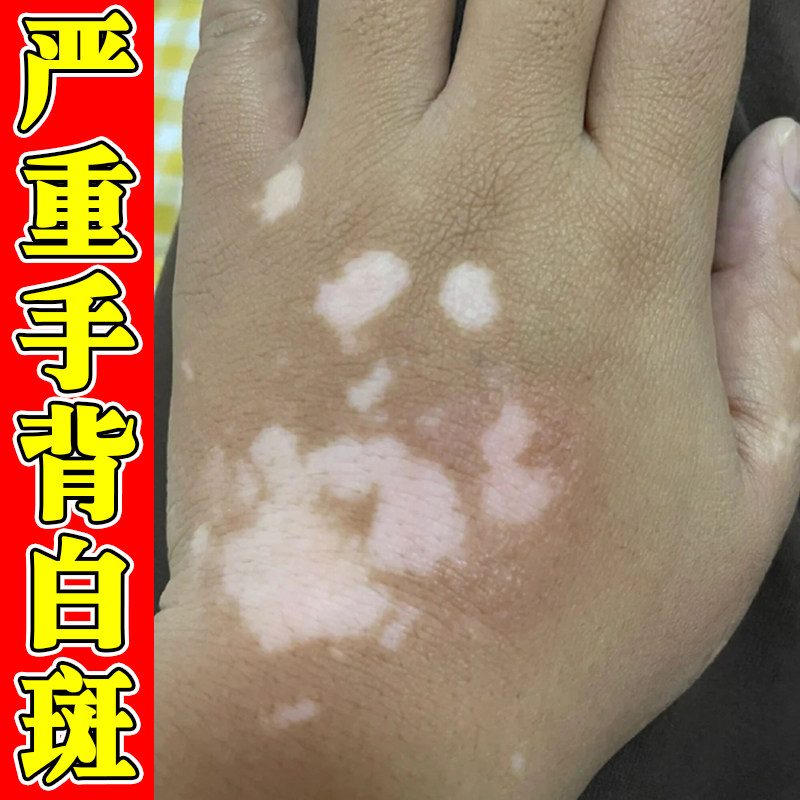 严重手背白斑外用修复黑色素生长补骨脂酊皮肤白斑外用