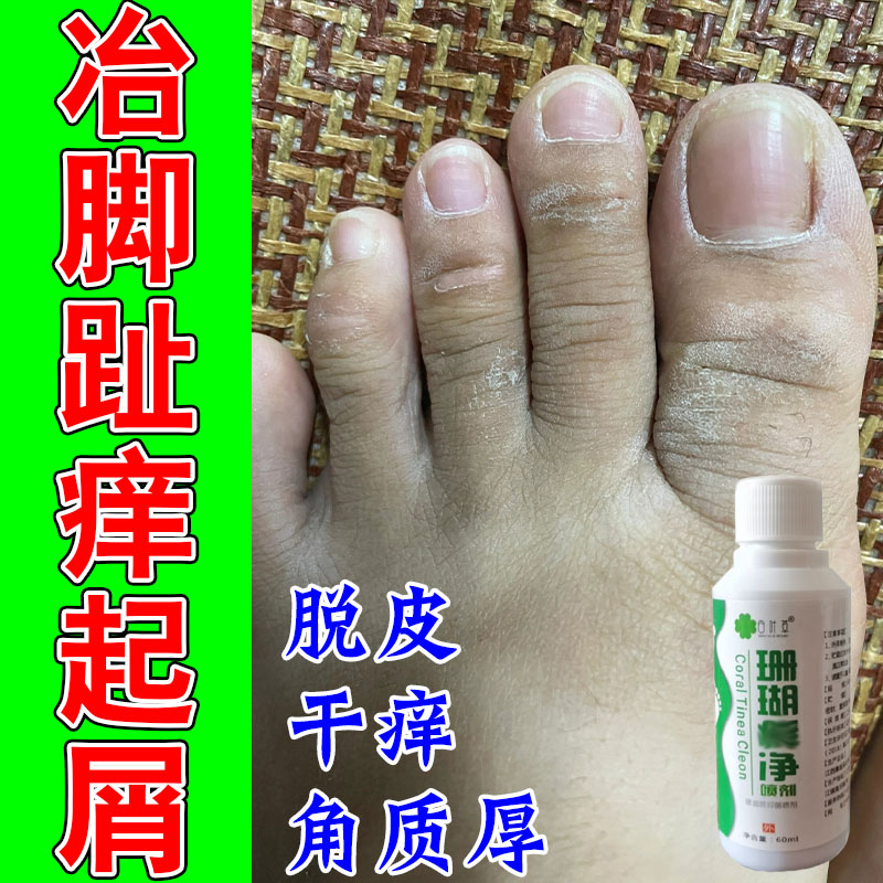 脚趾头红斑疙瘩改善脚趾关节起皮粗糙干燥起皮脚皮修护草本软膏