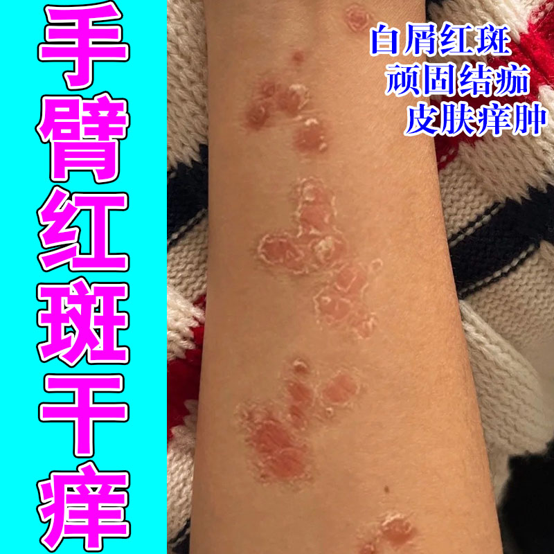 胳膊腿上长白屑红肿粗糙起皮痒脱皮神经真菌发痒修护保湿膏
