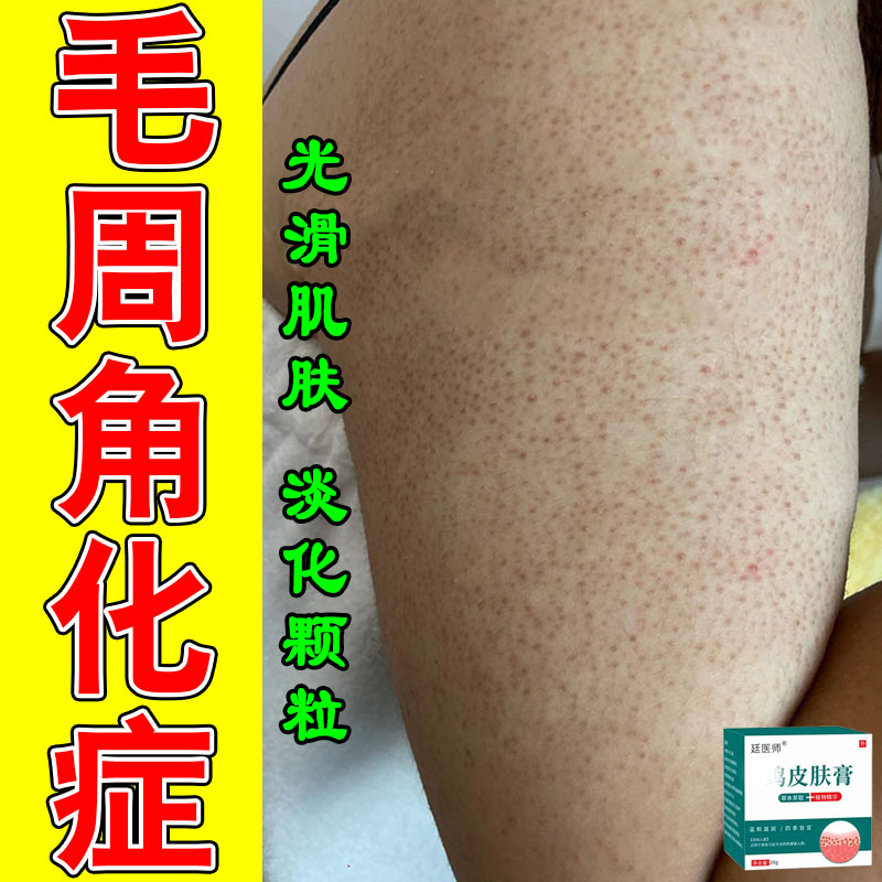 毛周角化胳膊角质厚重毛囊堵塞小疙瘩密布触感胳膊修护乳霜