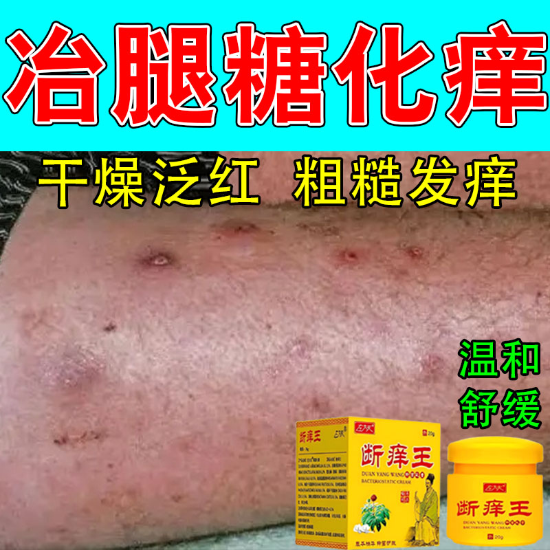 冶糖斑皮肤痒专用老年人高糖斑皮肤痒全身干燥脱皮暗沉色素修护膏