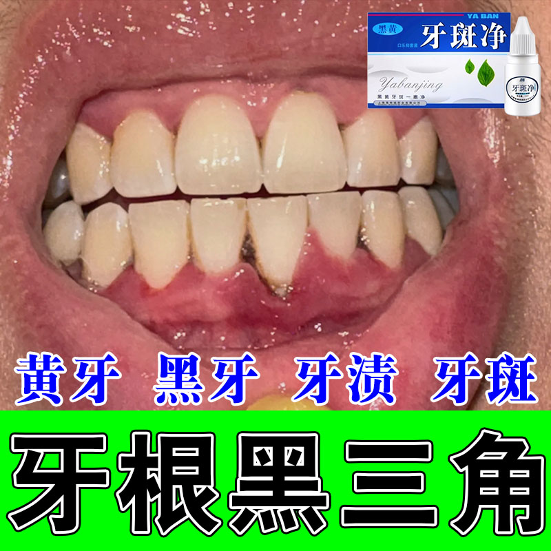 牙面黑线牙渍黑牙清洁牙缝隙牙菌斑牙齿窝沟黑线修护牙液