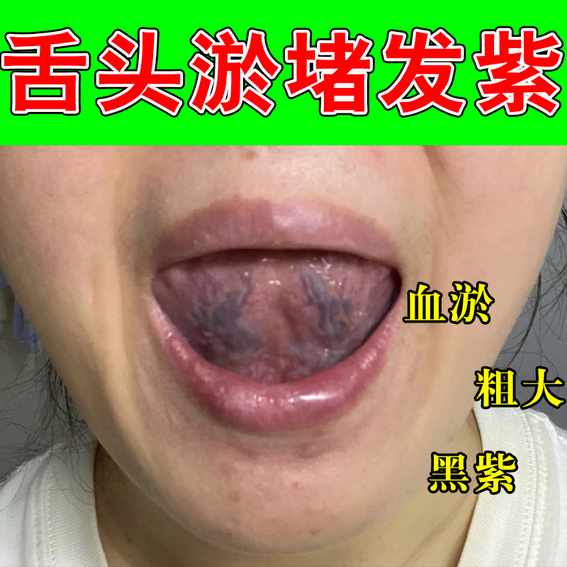 舌下血管淤堵青筋凸起红肿疼痛舌根胀痛草本温和修护疏通喷剂